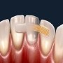 Особенности и варианты зубного шинирования